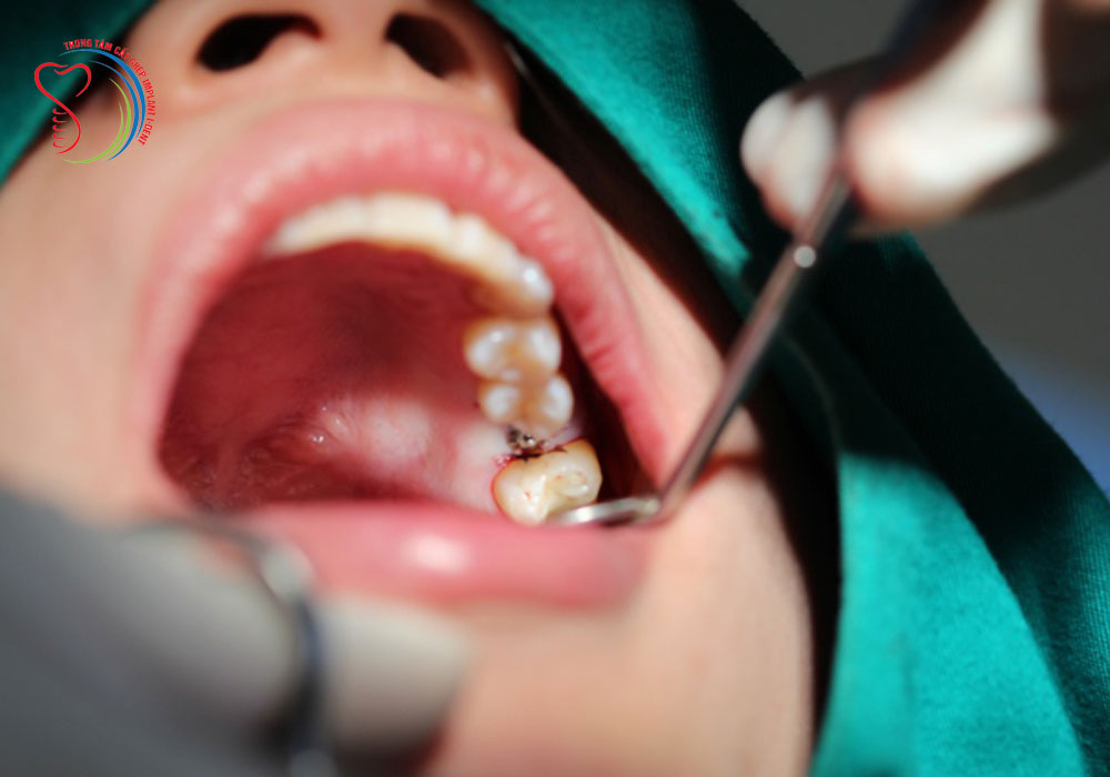 5 great benefits of dental implants