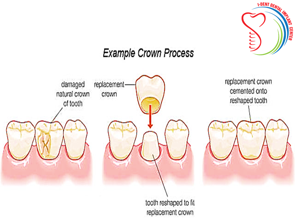 what is the purpose of a crown for teeth