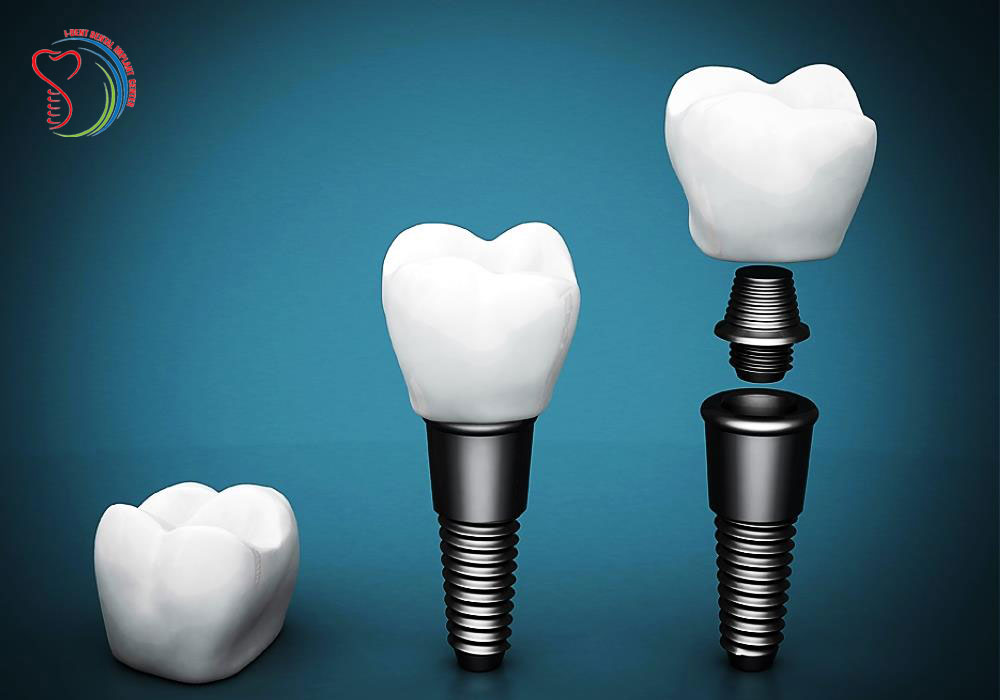 IMPLANT DENTISTRY - OPTIMAL SOLUTION FOR REPLACEMENT MISSING TEETH 