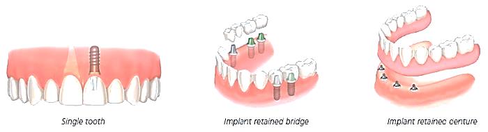Dental Implant Technique