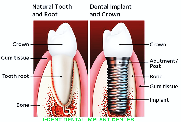 How is an implant tooth look?