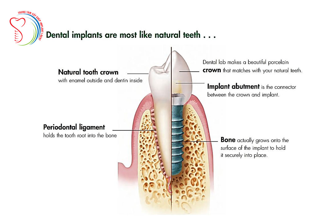 Why Dental Implants Is Your Best Option Of  Replacing Missing Teeth