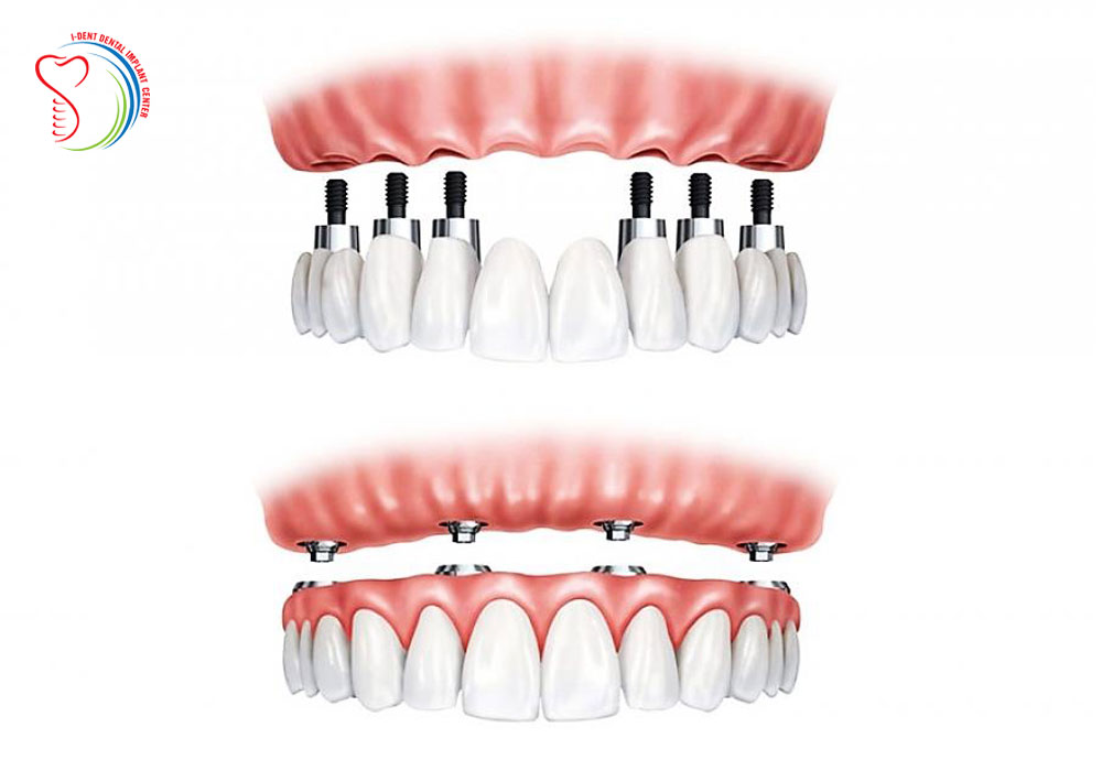 All on 4 and All on 6 techniques in dental implants