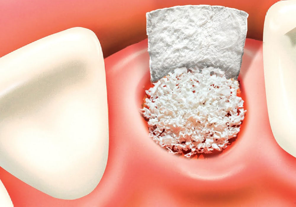 Bone Grafting in Dental Implants?