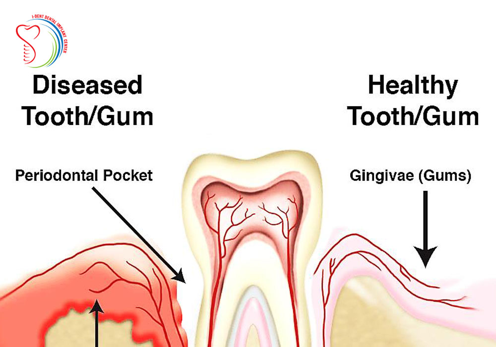 Periodontitis and how to protect your oral health