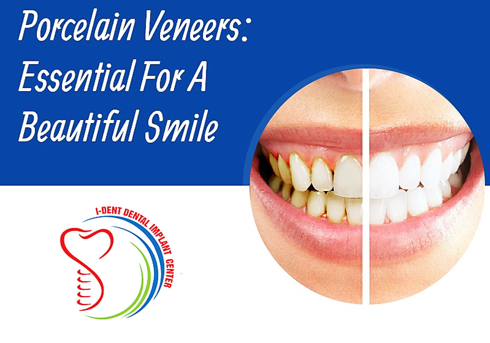 Questions related to dental porcelain veneers