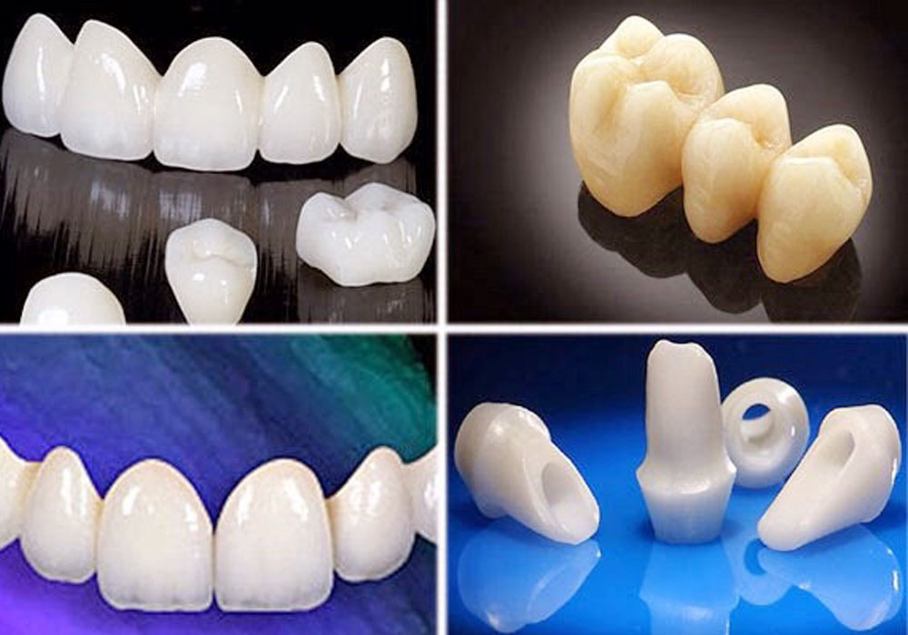 Types of Dental Porcelain Crown